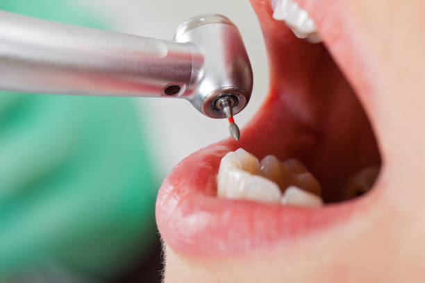 Best Emergency Wisdom Teeth Removal in Hampton Beach, NH
